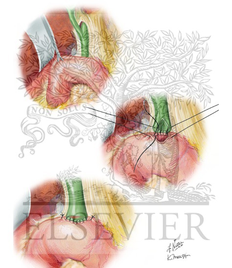 Watermarked preview of unlabeled image: Choledochoduodenostomy