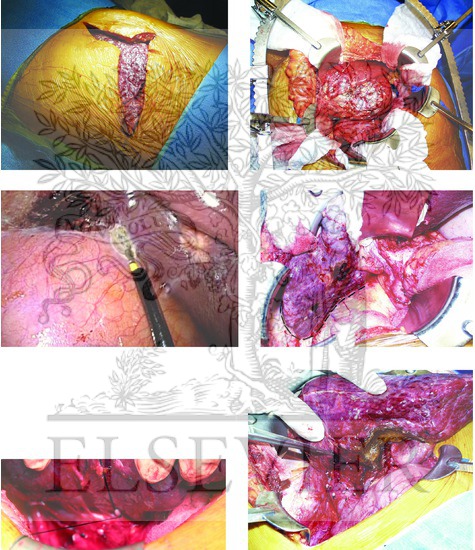 Watermarked preview of unlabeled image: Right Hepatic Lobectomy
