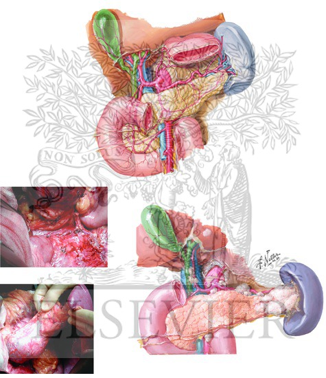 Division of Splenic Artery and Vein and Pancreas