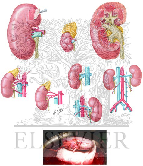 Watermarked preview of unlabeled image: Anatomic Variations of Kidney Allograft