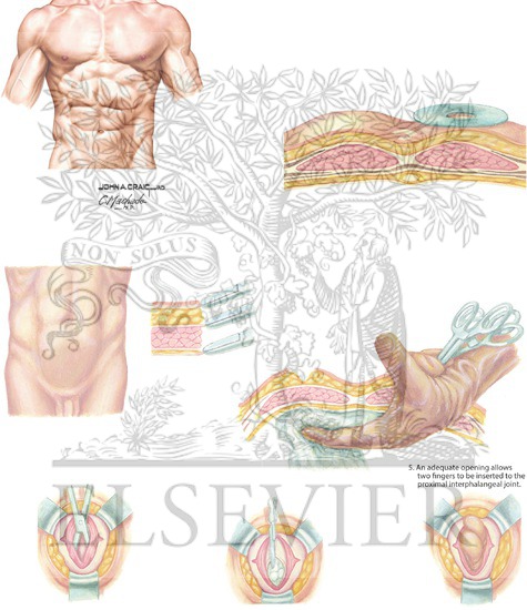Watermarked preview of unlabeled image: Ileostomy: Anatomic Landmarks and Surgical Technique
