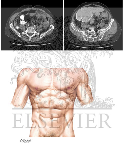 Left Colectomy: Authors' Preference for Laparoscopic Port Placement