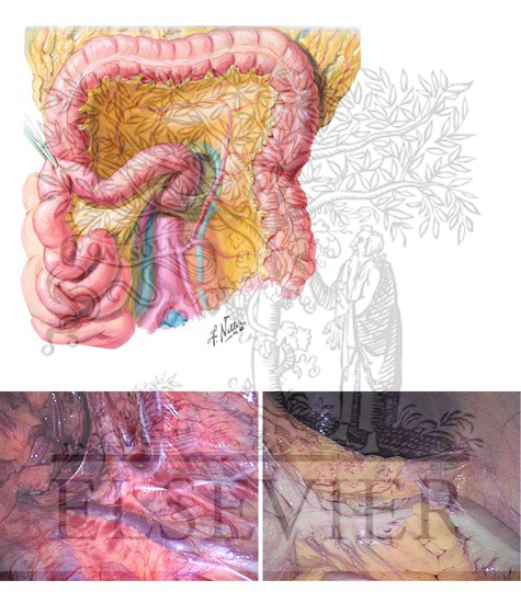 Inferior Mesenteric Vein and Splenic Flexure