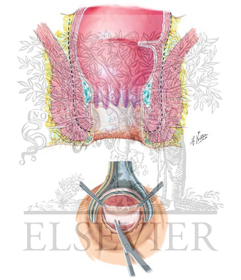Watermarked preview of unlabeled image: Intersphincteric Transanal Transection of Rectum