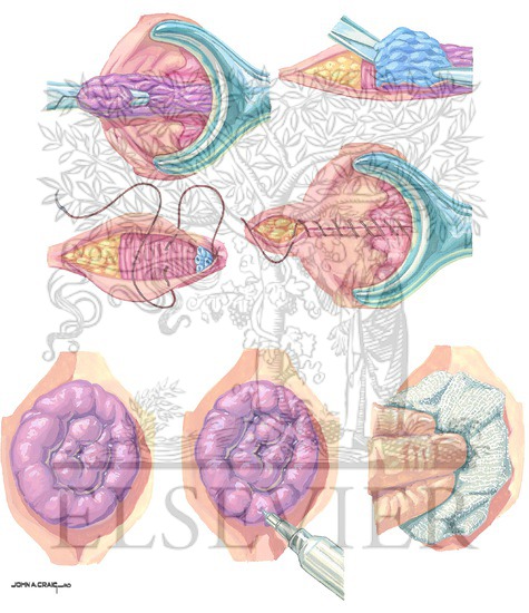 Watermarked preview of unlabeled image: Hemorrhoidectomy and Incarcerated (Strangulated) Hemorrhoids