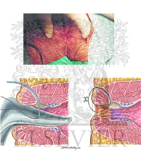 Perirectal Fistula Examination and Management