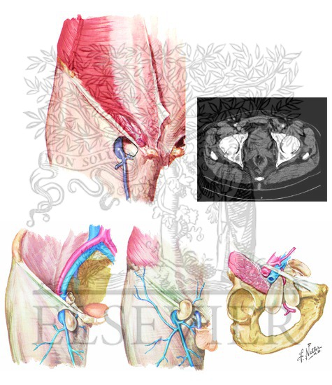 Anatomy of Femoral Hernia