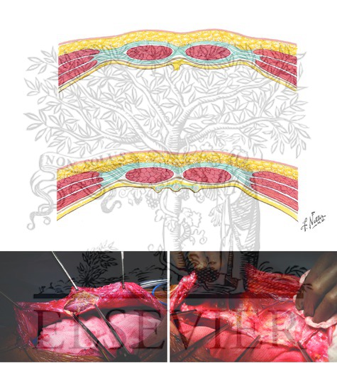 Watermarked preview of unlabeled image: Cross Section of Anterior Abdominal Wall and Creation of Retrorectus Space