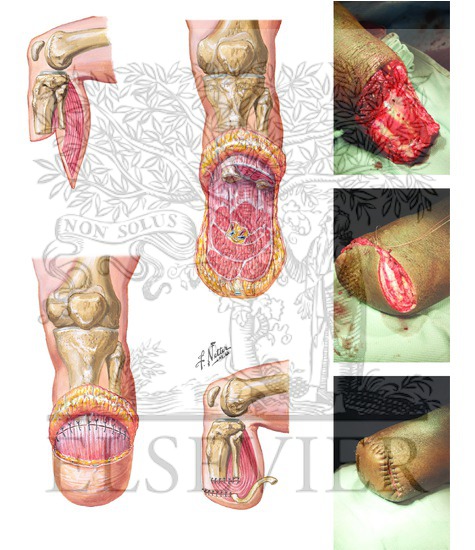 Watermarked preview of unlabeled image: Below-Knee Amputation and Closure
