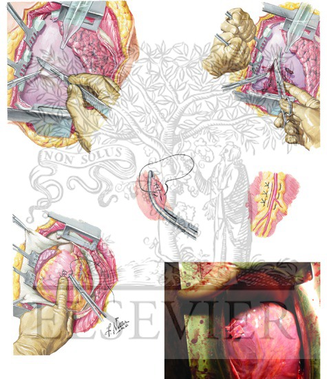 Pericardiotomy and Cardiorrhaphy
