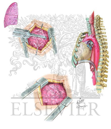 Pulmonary Tractotomy