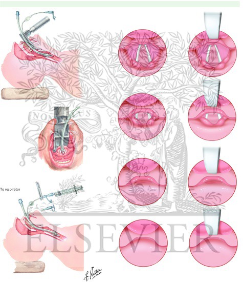 Laryngoscopy
