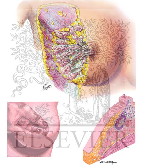 Watermarked preview of unlabeled image: Duct Excision and Intraductal Papilloma