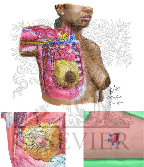 Watermarked preview of unlabeled image: Sentinel Lymph Node Biopsy