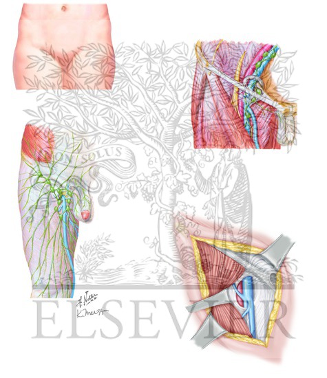 Inguinal Lymph Node Dissection