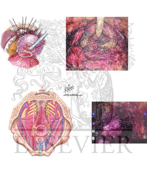 Bladder Neck Dissection and Neurovascular Bundle