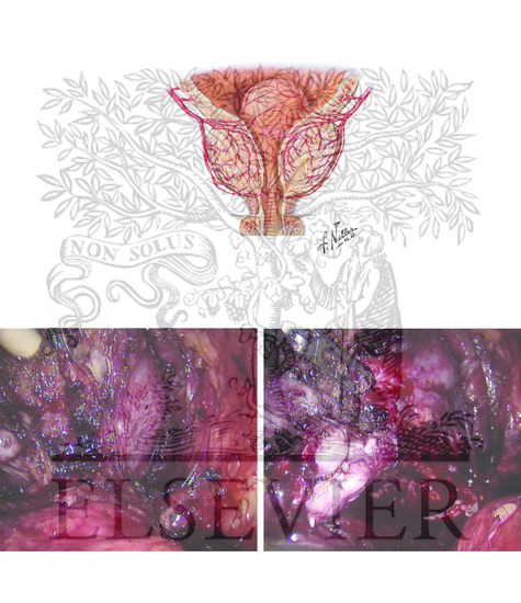 Prostatic Pedicle Ligation and Division of Deep Dorsal Venous Plexus