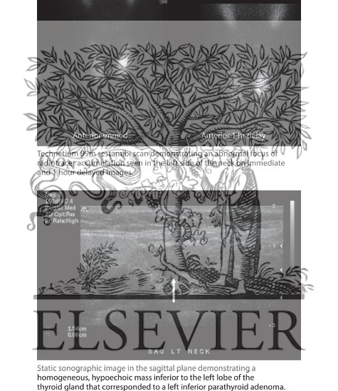 Watermarked preview of labeled image: Preoperative Imaging of Neck: Scintigram and Sonogram