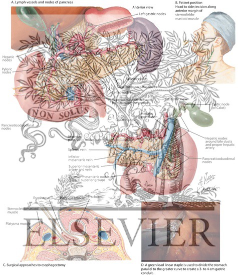 Transhiatal Esophagectomy