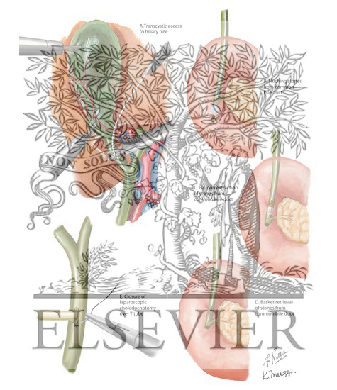Watermarked preview of labeled image: Transystic and Transductal/Choledochotomy Approaches
