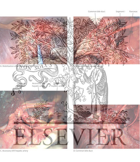 Watermarked preview of labeled image: Left Hepatic Lobectomy