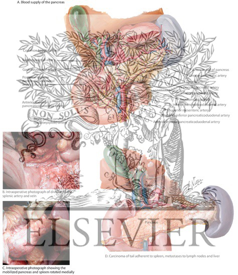 Watermarked preview of labeled image: Division of Splenic Artery and Vein and Pancreas