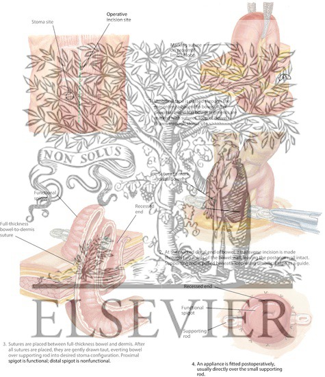 Watermarked preview of labeled image: Loop-End Iliostomy Technique