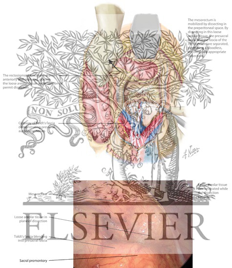 Watermarked preview of labeled image: Upper Posterior Mesorectal Dissection