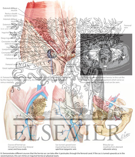 Anatomy of Femoral Hernia