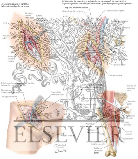 Avoiding the Femoral Artery