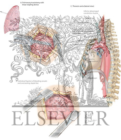 Pulmonary Tractotomy