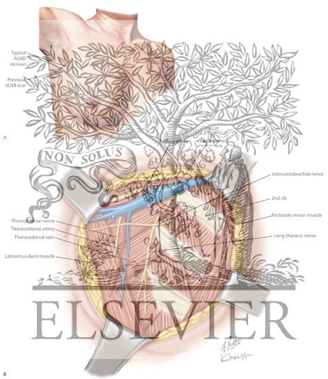 Axillary Lymph Node Dissection