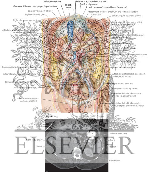Watermarked preview of labeled image: Retroperitoneal Anatomy and CT Scan of Large Tumor