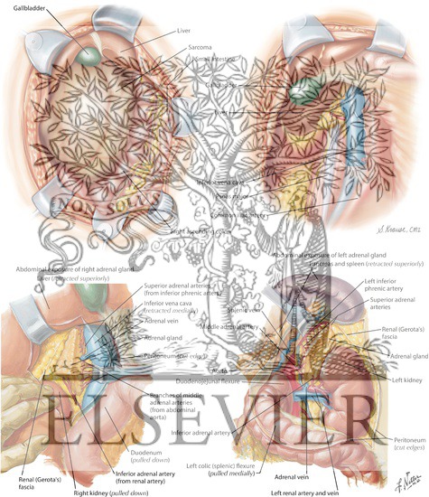 Watermarked preview of labeled image: Abdominal Exposure of Retroperitoneal Tumor