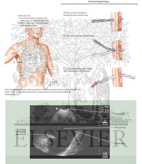 Introduction of Chest Drainage Tubes