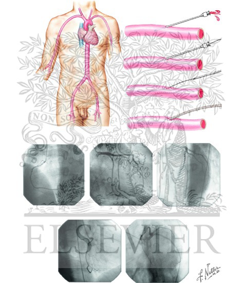 Cardiac Catheterization: Left-Sided Heart Catheterization