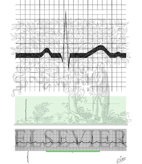 Electrocardiogram