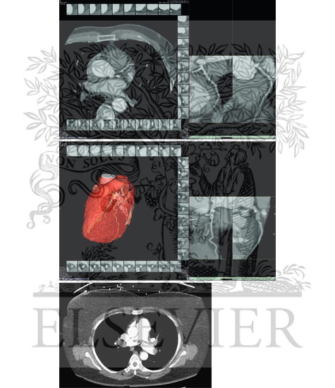 Watermarked preview of unlabeled image: Computed Tomographic Angiography: Interpretation