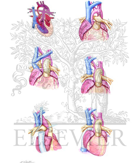 Anomalies of Left Ventricular Outflow Tract: Norwood Correction of Hypoplastic Left Heart Syndrome