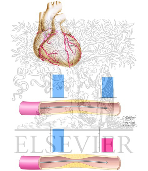 Watermarked preview of unlabeled image: Fractional Flow Reserve