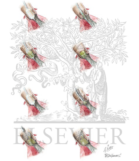 Watermarked preview of unlabeled image: Percutaneous Aortic Valve (Edwards Sapien and CoreValve) Replacement