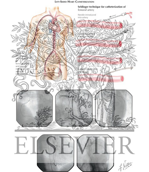 Cardiac Catheterization: Left-Sided Heart Catheterization