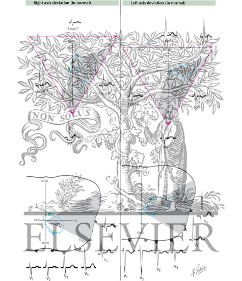Watermarked preview of labeled image: Axis Deviation in Normal Electrocardiogram
