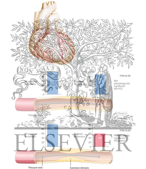 Watermarked preview of labeled image: Fractional Flow Reserve