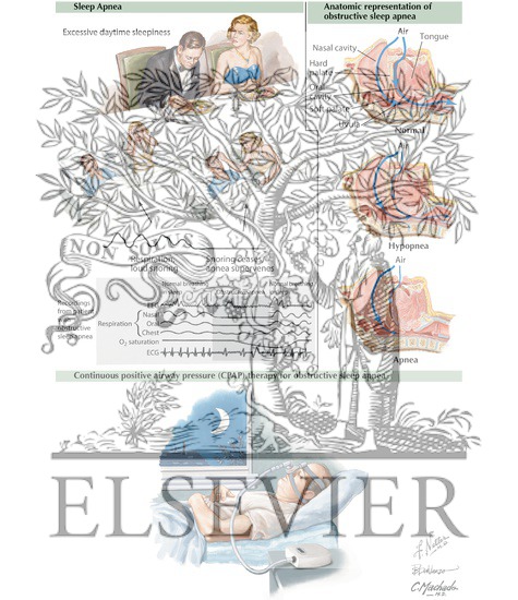 Watermarked preview of labeled image: Obstructive Sleep Apnea and Hypertension