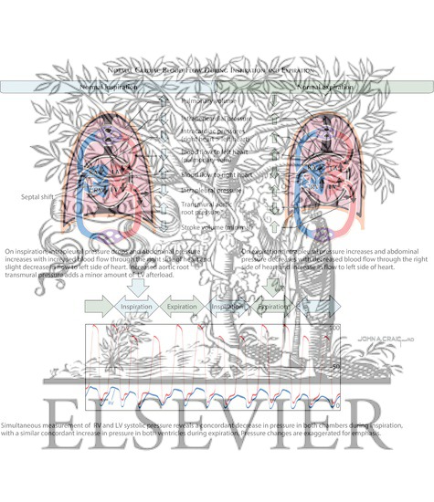 Watermarked preview of labeled image: Normal Cardiac Blood Flow During Inspiration and Expiration