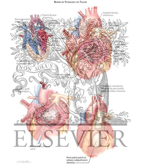 Watermarked preview of labeled image: Tetralogy of Fallot