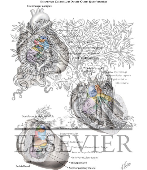 Watermarked preview of labeled image: Anomalies of the Right Ventricular - Outflow Tract