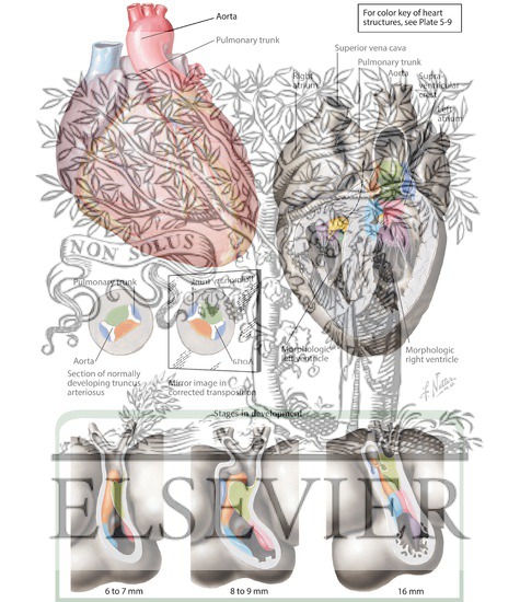 Watermarked preview of labeled image: Transposition of the Great Vessels with Inversion of the Ventricles (Corrected Transposition of the Great Vessels)