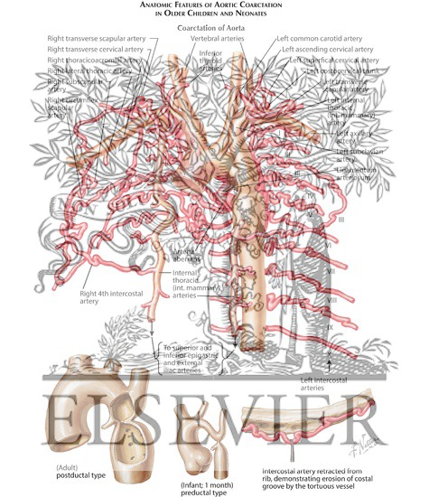 Intersegmental Arteries and coarctation of the Aorta